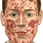 acne-example